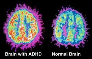 Cure ADHD with meditation