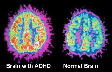 Cure ADHD with meditation